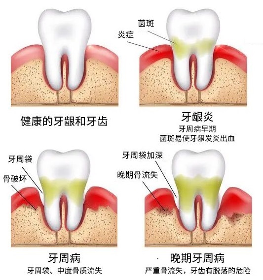 深圳牙周炎治療費(fèi)用