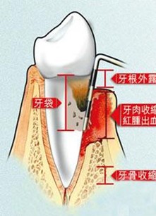 牙齒疼痛的病癥和癥狀？