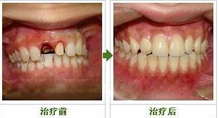 種植牙效果圖