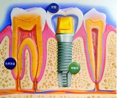 種植牙安不安全