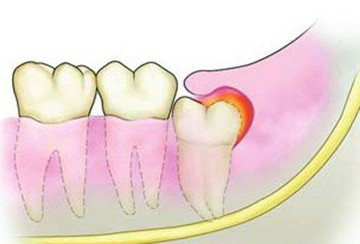 智齒冠周炎的表現(xiàn)和治療方法！
