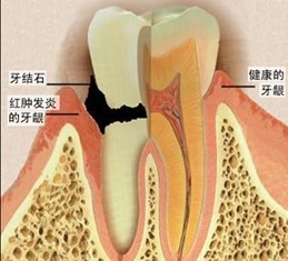 牙結(jié)石的危害