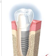種植牙的優(yōu)點