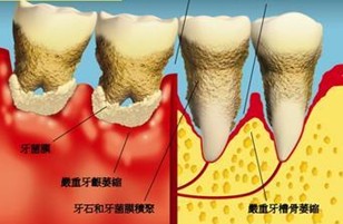 牙周炎易患人群有4種