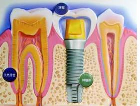 拔牙之后能不能立刻做種植牙