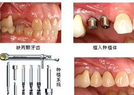 全口牙齒缺失應(yīng)該怎么辦