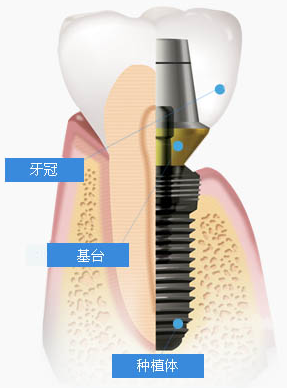 種植牙的注意事項(xiàng)