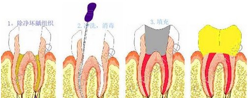 補牙過程細(xì)節(jié)揭秘！