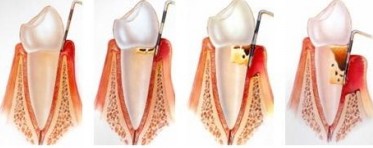 牙周炎的7個典型癥狀？