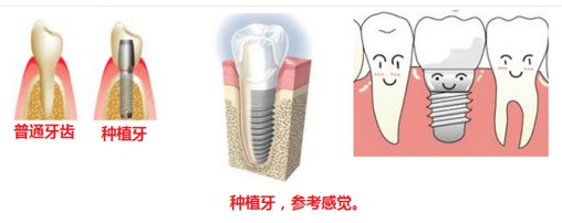 長期牙齒缺失還可以做種植牙嗎？