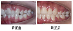  牙    齒矯正
什么時(shí)候可以做？