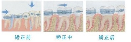 牙齒矯正期間四大注意事項(xiàng)