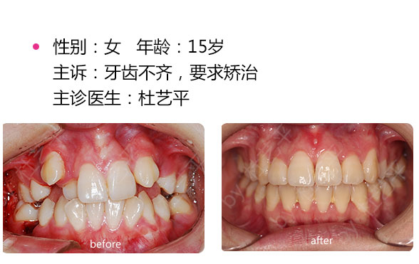 深圳哪些因素影響地包天矯正手術(shù)的價(jià)格