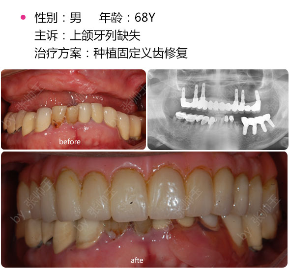 深圳全口種植多少錢(qián)