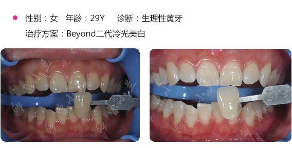 深圳冷光美白和洗牙有什么不一樣