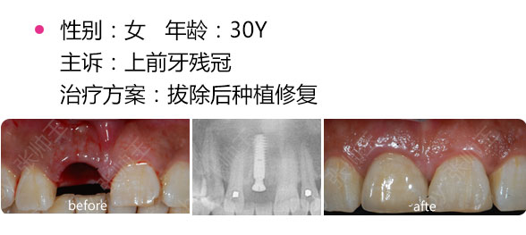 拔牙后可以馬上種牙嗎？