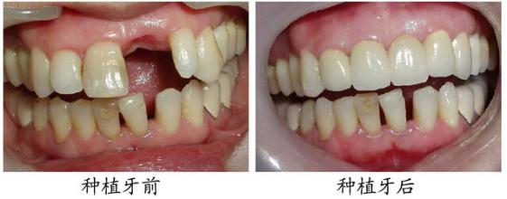 微創(chuàng)速導種植如何保障率？