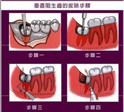 深圳拔智齒多少錢一顆？