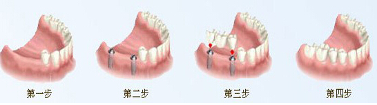 種植牙如何避免“盲種”？