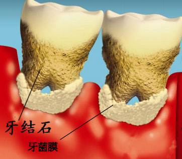 牙結(jié)石相關(guān)知識解答