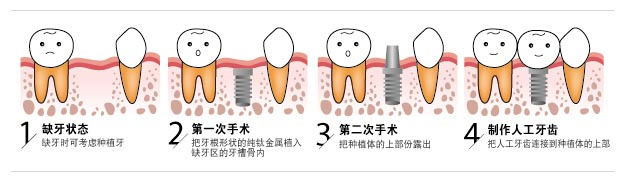 種植牙人人合適嗎？