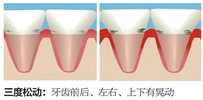 這些原因可能引起牙齒松動