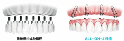 all-on-4種植是怎樣種牙的？
