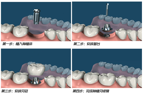 缺牙后何時(shí)種牙比較好？