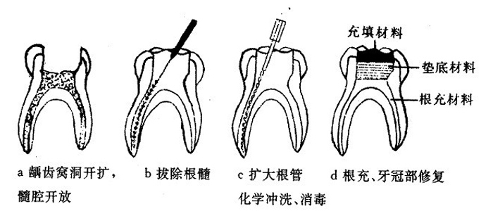 根管治療后為什么還要做牙冠？