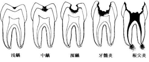 齲齒不痛還需要治療嗎？