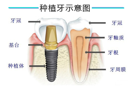 種植牙如何延長(zhǎng)使用壽命？