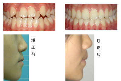 矯牙期間出現(xiàn)疼痛怎么辦？