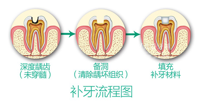 蛀牙修補(bǔ)后應(yīng)該注意些什么？