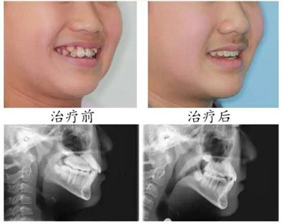 兒童牙齒不齊有什么影響？