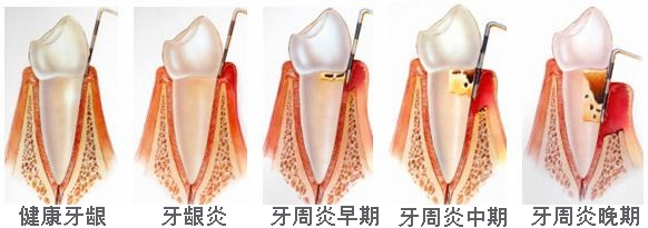 牙周病到底是如何形成的？