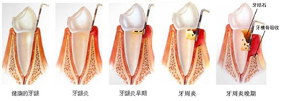 牙齦炎會(huì)導(dǎo)致哪些并發(fā)癥？