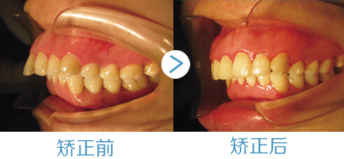 齙牙的危害有哪些？