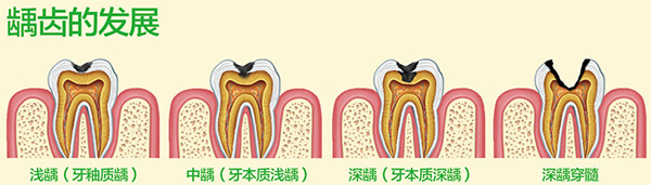 深度齲齒怎么治療？