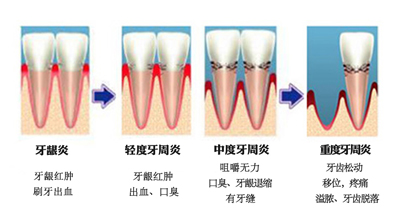 如何有效預(yù)防牙周炎？