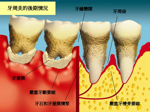 牙周炎有哪些危害？