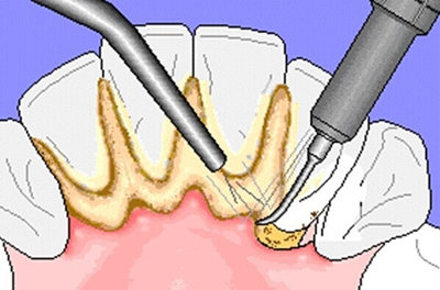 3個方法教你去除牙結(jié)石