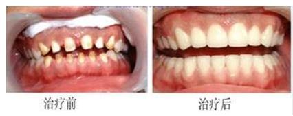 深圳哪家醫(yī)院做烤瓷牙的技術好？