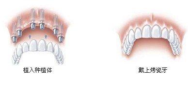 全口種植牙有哪些需要注意的？