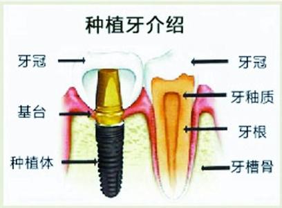 如何正確保養(yǎng)種植牙？