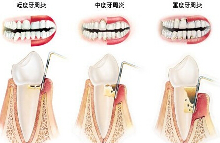 哪些方法可以預(yù)防牙周炎？