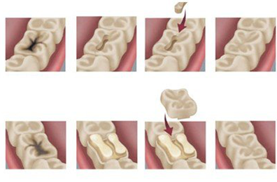 蛀牙補(bǔ)牙用什么材料比較好？