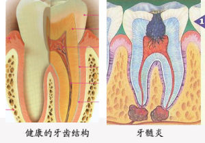 導(dǎo)致急性牙髓炎的原因有哪些？