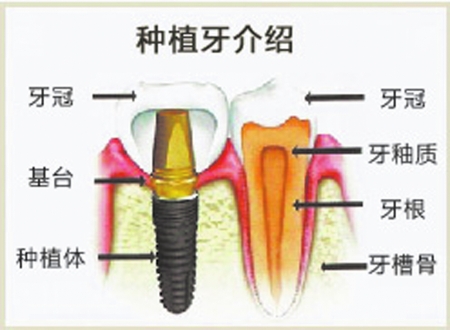 種植體脫落怎么辦？