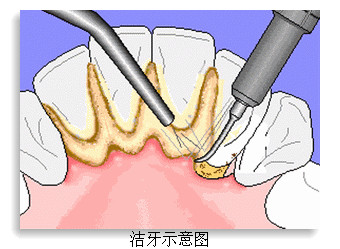 洗牙前要注意哪些事項？