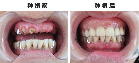 半口牙缺失做種植牙時(shí)間久嗎？